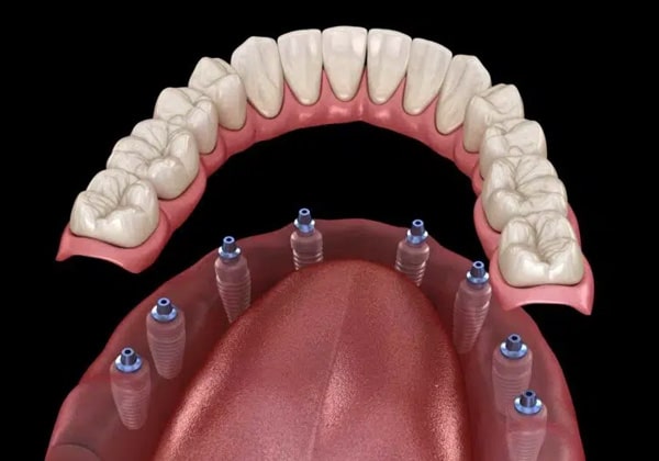 All-on-8-Implants