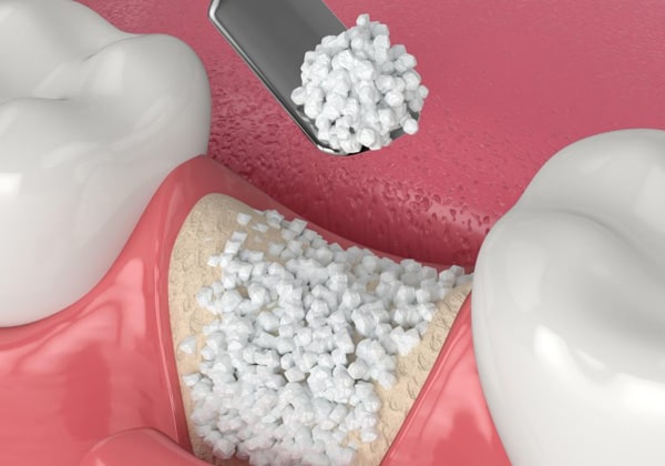 Bone-Grafting
