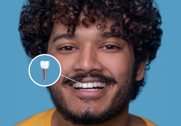 Dental Implants