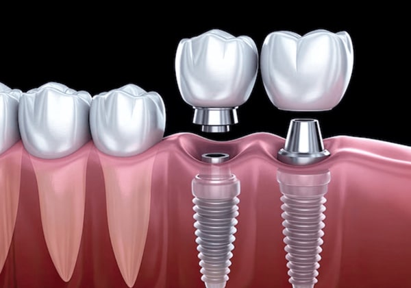 Implants