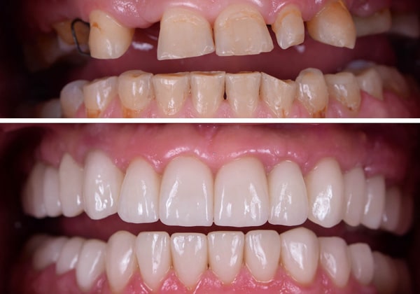 Mouth-Rehab