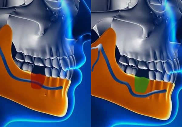 Nerve-Reposition