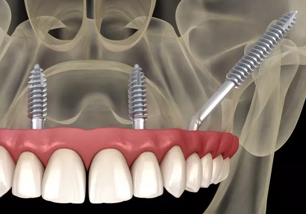 Pterygoid-Implants