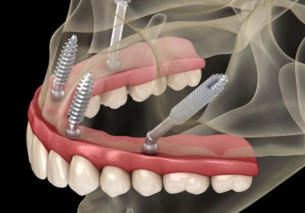 Zygomatic-Implants